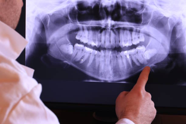 Best Emergency Treatment for Dental Infections or Abscesses in Tladega, AL